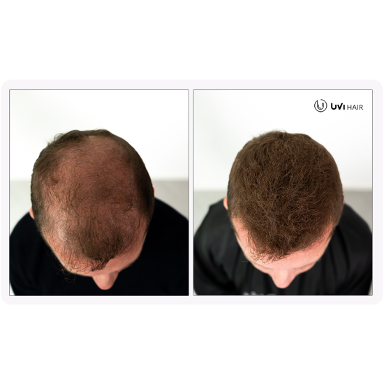 UVI Hair Fiber Dark Brown large 27.5g bottle of natural keratin hair thickening fibres, suitable for men and women, up to 50 applications